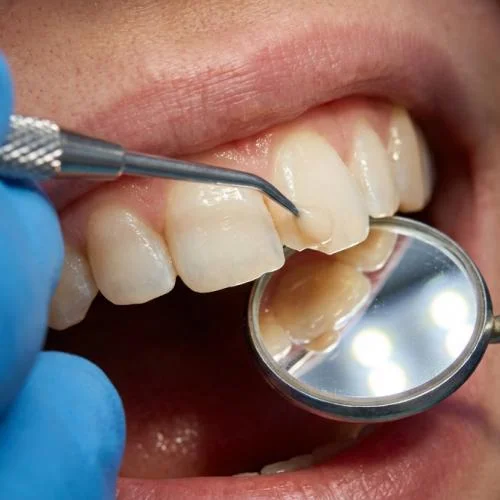 Benefits of veneers in Huddersfield for improving the appearance of your smile